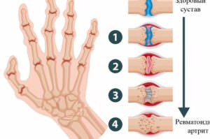 Лечение ревматоидного артрита пальцев рук: эффективные методы и рекомендации