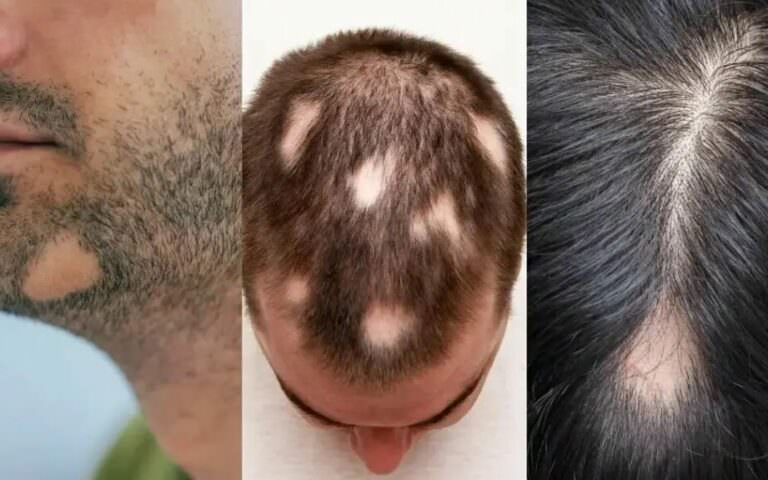 Очаговая алопеция — симптомы и эффективные методы лечения
